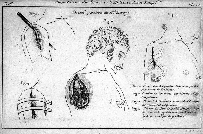 Amputation par désarticulation (Larrey, 1836)