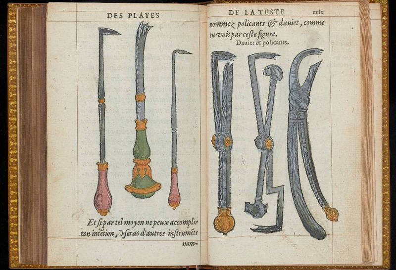 La methode curative des playes (Paré, 1561)